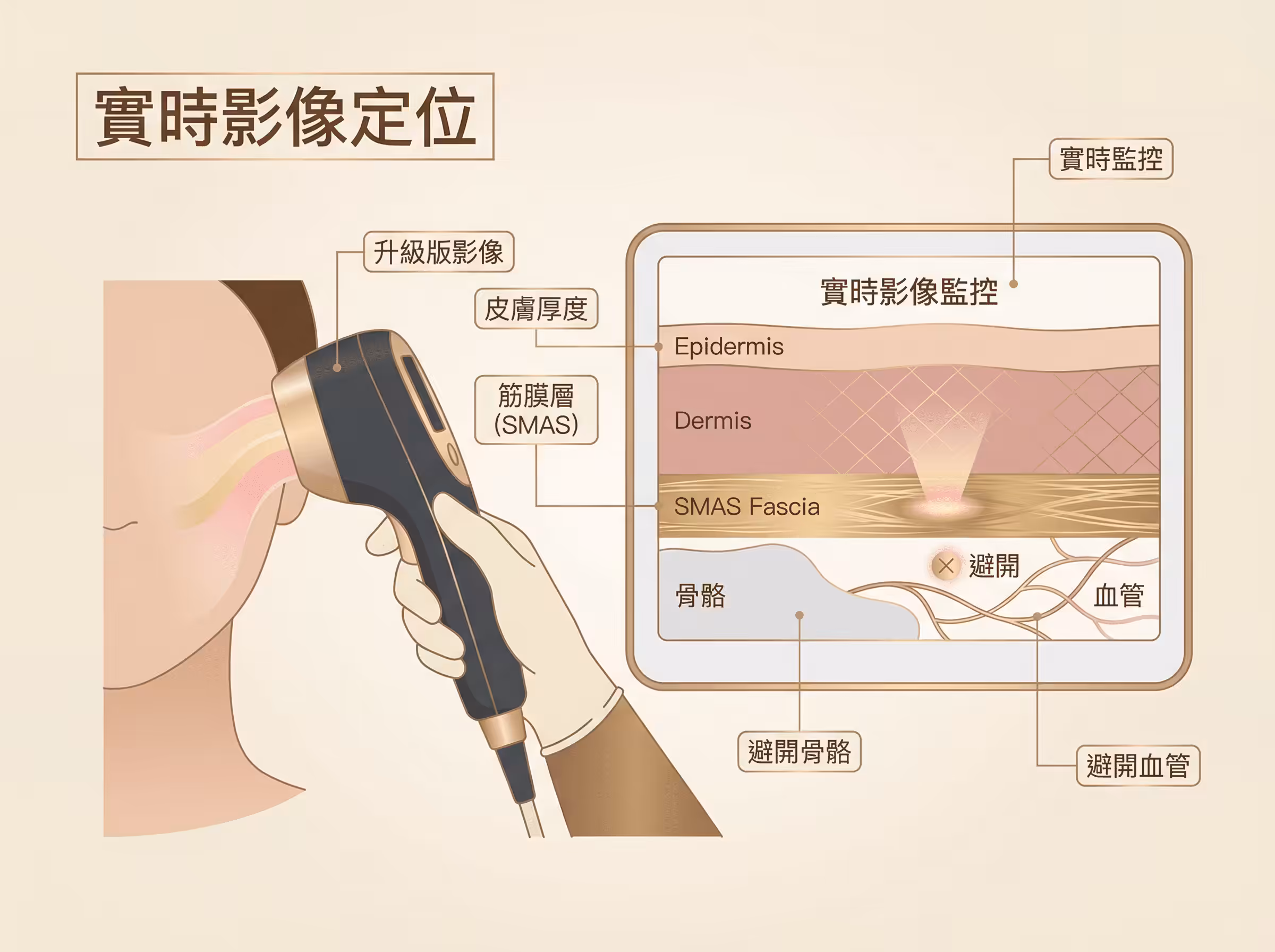 醫生操作 Ultherapy Prime 實時影像螢幕示意圖