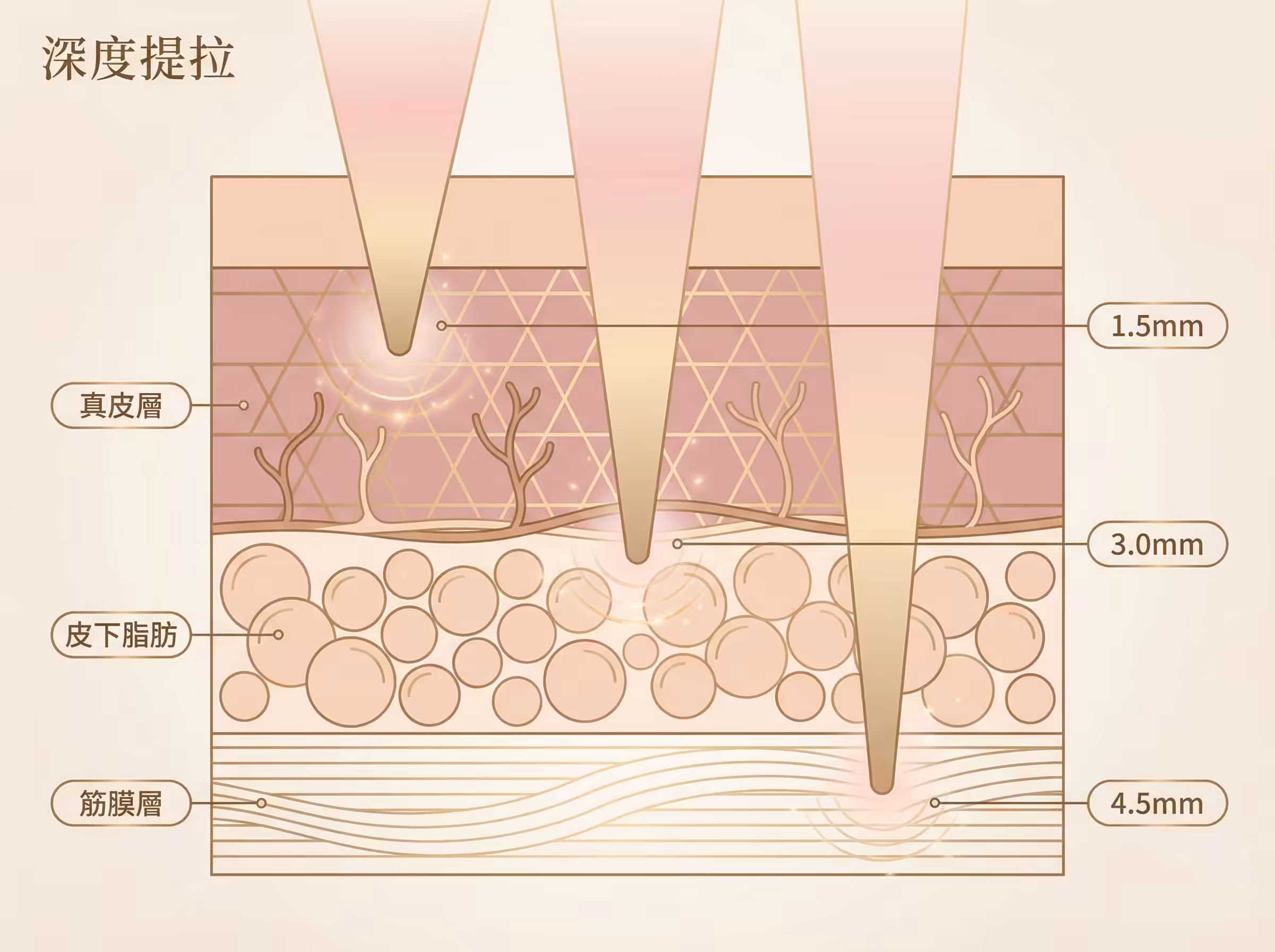 Ultherapy Prime 提拉向量與解剖學深度示意圖