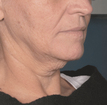 Ultherapy Prime 適用於下顎線與面部輪廓