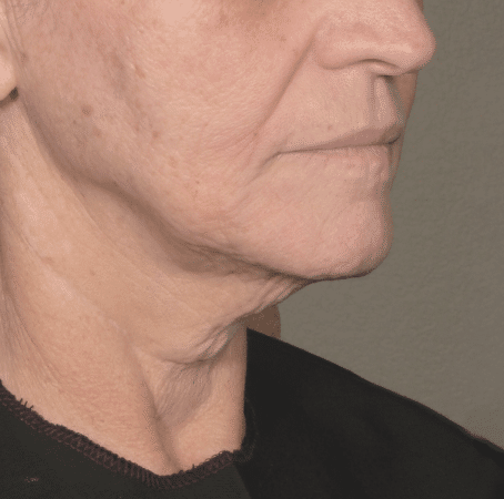 Ultherapy Prime 適用於下顎線與面部輪廓